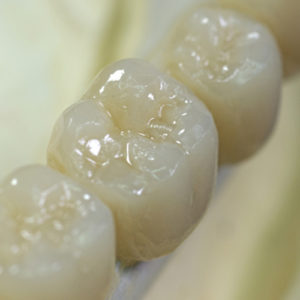 dental crowns