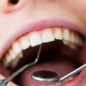 dental fillings