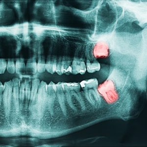 3 things to know about wisdom teeth