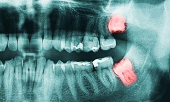 3 things to know about wisdom teeth