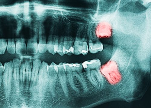 3 things to know about wisdom teeth