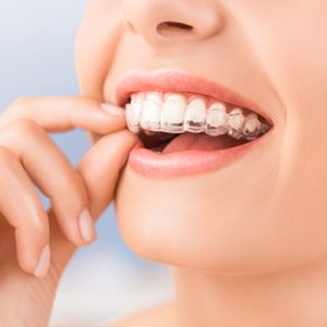 questions about invisalign