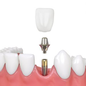 why dental implants are expensive