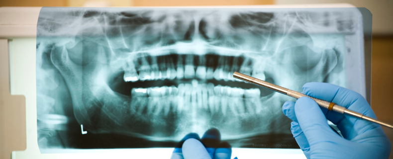 root canal explained